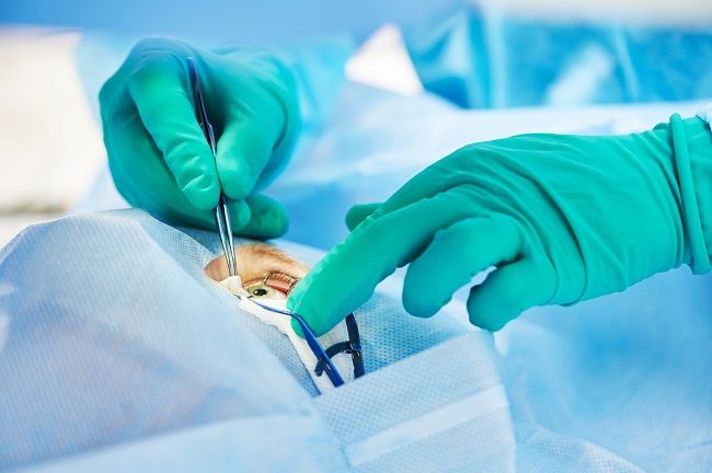 Berapa Usia Minimal untuk Operasi LASIK