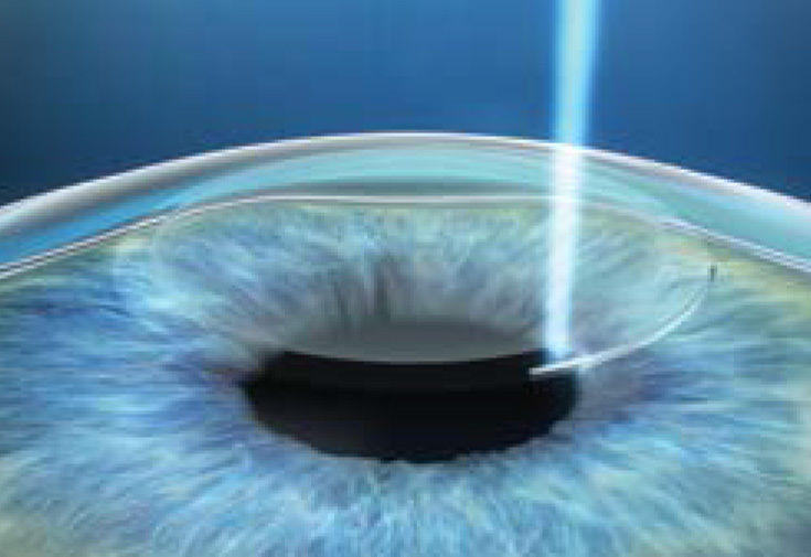 Femto LASIK vs ReLex SMILE Pro: Memilih Prosedur Bedah Mata yang Tepat