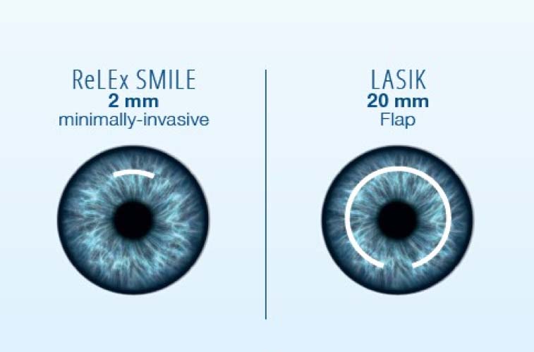 Perbedaan Metode LASIK PRK, FemtoLASIK, dan SMILE Pro