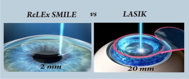 Perbedaan ReLEx Smile Pro vs ReLEx Smile