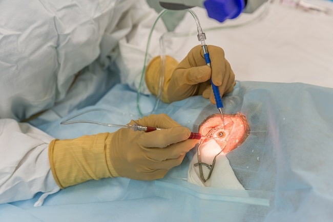 Perbandingan Biaya Operasi ReLEx Smile Pro dan Operasi LASIK