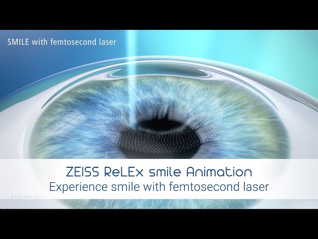 7 Alasan Zeiss SMILE Pro Lebih Unggul Dibandingkan LASIK